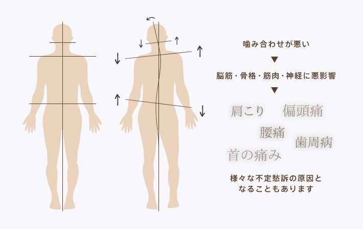 噛み合わせが悪いと、脳筋・骨格・筋肉・神経に悪影響を及ぼし、肩こり・偏頭痛・腰痛・歯周病・首の痛みなど様々な不定愁訴の原因と
なることもあります